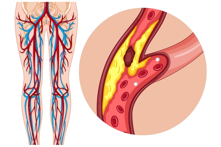Peripheral Neuropathy-img2 Peripheral Neuropathy-img2